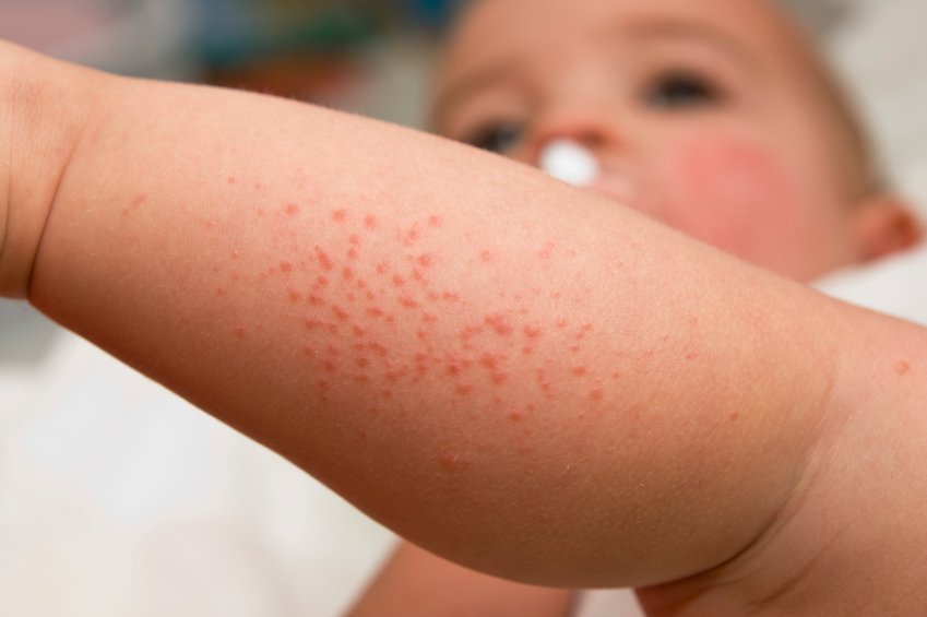 eczema on baby